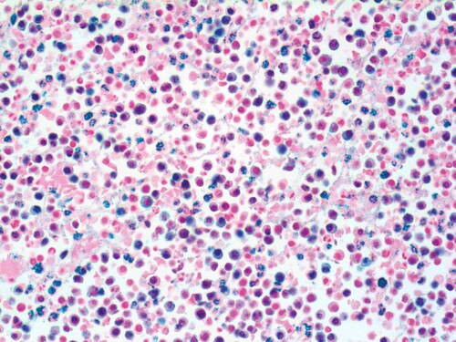 IHC of HHV-8 Antibody Immunohistochemistry on a FFPE Infected Pleura Tissue